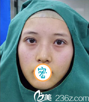 术后即刻无明显出血及肿胀