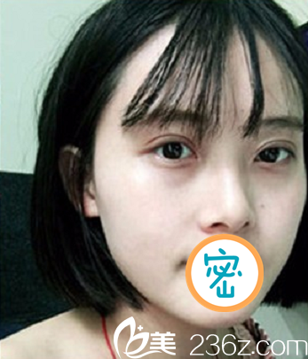 <!--<i data=20240703-sp></i>-->双眼皮术后7天照