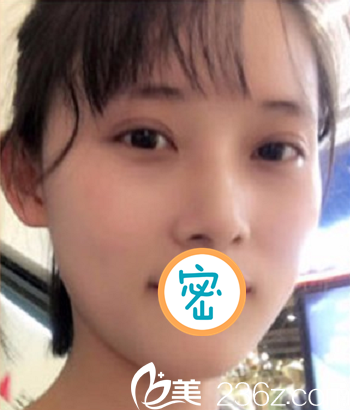 彭太平光子刀双眼皮说一个月