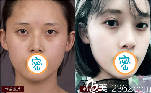 彭太平双眼皮案例前后对比照