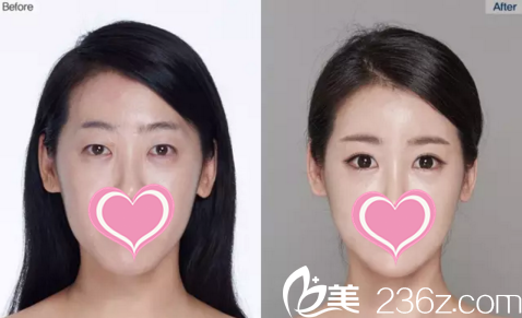 面部整形前后效果对比 面部整形前后效果对比