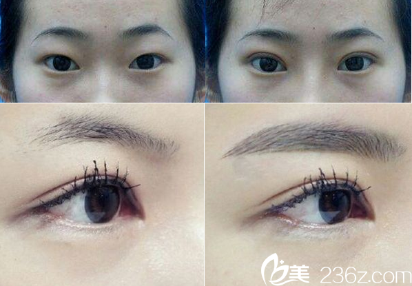 聊城韩美双眼皮和半纹眉案例对比图