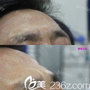 玻尿酸除皱注射后效果