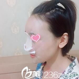 隆鼻+自体脂肪填充术后天 隆鼻+自体脂肪填充术后天