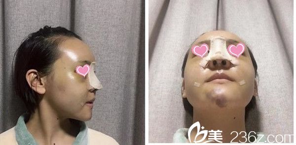 术后第5天 术后第5天