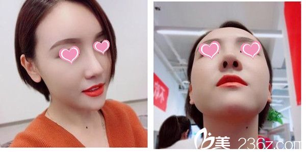 术后一个月效果 术后一个月效果