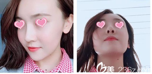 术后两个月效果 术后两个月效果