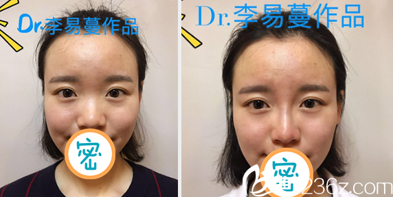 达州双均李易蔓线雕隆鼻案例对比