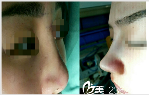 术后即刻照片 术后即刻照片