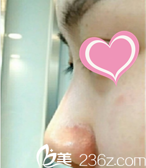 在北京知音医疗美容做隆鼻术前照片 在北京知音医疗美容做隆鼻术前照片