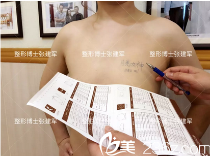 广州博仕张建军隆胸术前设计图