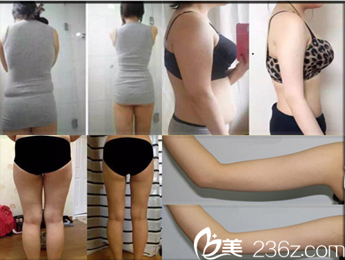 韩国济州岛天使女性综合医院美容整形溶脂瘦身案例