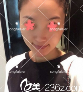 鼻综合术前 鼻综合术前