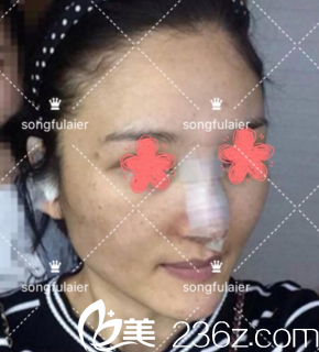 鼻综合手术后3天 鼻综合手术后3天