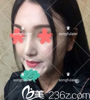 鼻综合术后半个月 鼻综合术后半个月