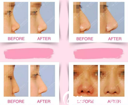 世贤整形外科鼻部修复案例 世贤整形外科鼻部修复案例