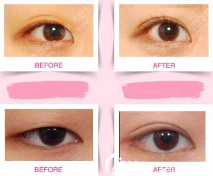 世贤整形医院眼部案例 世贤整形医院眼部案例