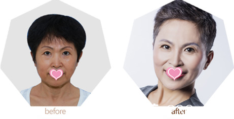 北京上上相整形美容医院面部精雕案例