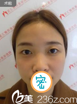 切开双眼皮术前眼睛无神 切开双眼皮术前眼睛无神