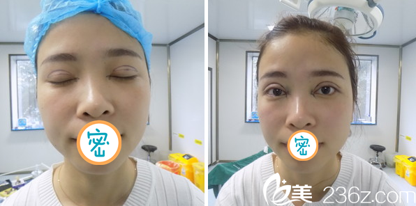 双眼皮术前设计及术后即刻效果 双眼皮术前设计及术后即刻效果