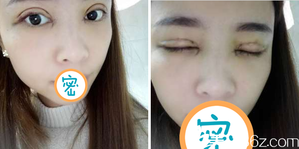 切开双眼皮术后5天睁眼闭眼效果 切开双眼皮术后5天睁眼闭眼效果