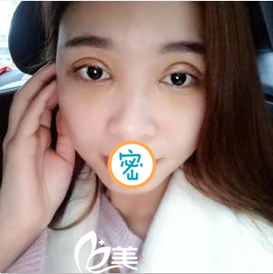 双眼皮+开眼角术后8天肿胀比较厉害 双眼皮+开眼角术后8天肿胀比较厉害