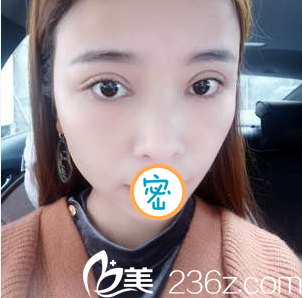 绵阳茗汇双眼皮+开眼角术后半个月 绵阳茗汇双眼皮+开眼角术后半个月