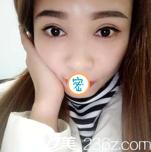 切开双眼皮+开眼角术后化妆照 切开双眼皮+开眼角术后化妆照