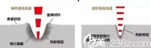 超皮秒祛斑治疗速度优势 超皮秒祛斑治疗速度优势