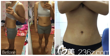 深圳贝漾美冯卫医生腰腹部抽脂案例对比图