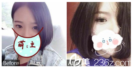 深圳贝漾美冯卫医生做的双眼皮案例