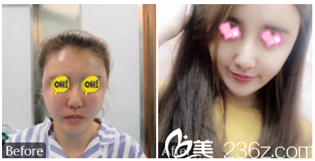 深圳贝漾美冯卫医生做的面部脂肪填充案例