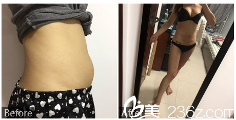 深圳贝漾美冯卫医生大腿及腰腹部抽脂案例