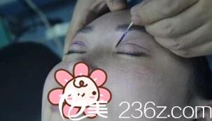 金沅硕院长给我手术中