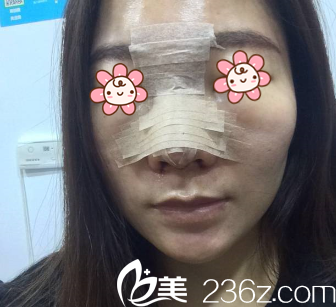 术后第三天 术后第三天