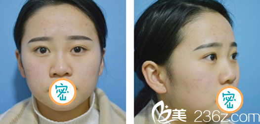 达州双均玻尿酸隆鼻术前照 达州双均玻尿酸隆鼻术前照