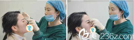 达州双均李易蔓注射玻尿酸隆鼻 达州双均李易蔓注射玻尿酸隆鼻