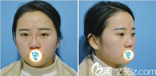 李易蔓玻尿酸隆鼻术后即刻效果 李易蔓玻尿酸隆鼻术后即刻效果