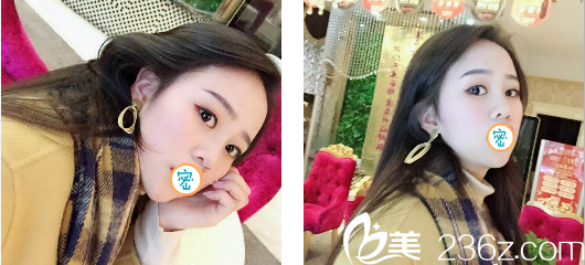 玻尿酸隆鼻+瘦脸术后7天效果 玻尿酸隆鼻+瘦脸术后7天效果