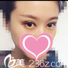 双眼皮修复一周效果