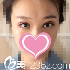 双眼皮修复术第三天