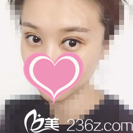 双眼皮修复半个月样子