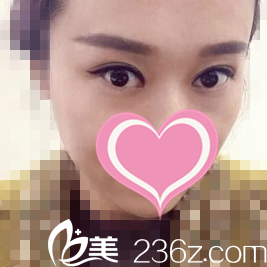 修复双眼皮一个月效果