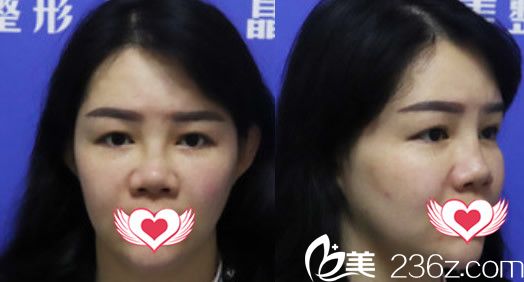 在美容院做注射隆鼻失败案例照片 在美容院做注射隆鼻失败案例照片