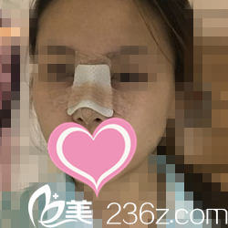 鼻整形术后第五天状况