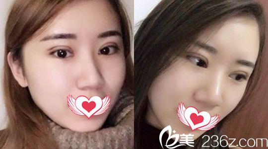 找合肥壹加壹整形外科医院甘泉涌割双眼皮第3天恢复情况图