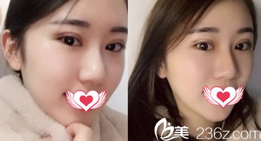 合肥壹加壹整形美容医院甘泉涌全切双眼皮整形案例术后第6天拆线后样子