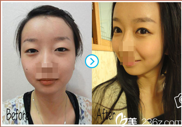 赣州明珠丽格医疗美容医院双眼皮手术案例