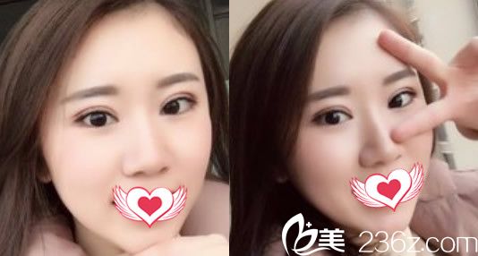 去合肥壹加壹整形美容医院割双眼皮术后第9天效果展示