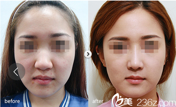 赣州明珠丽格医疗美容医院隆鼻手术真人案例